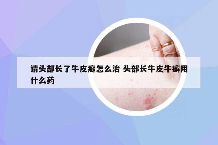 请头部长了牛皮癣怎么治 头部长牛皮牛癣用什么药