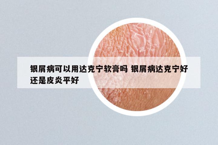 银屑病可以用达克宁软膏吗 银屑病达克宁好还是皮炎平好