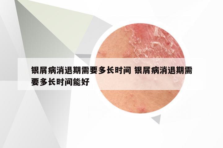 银屑病消退期需要多长时间 银屑病消退期需要多长时间能好