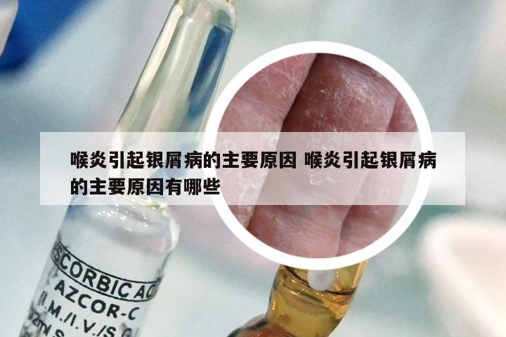 喉炎引起银屑病的主要原因 喉炎引起银屑病的主要原因有哪些