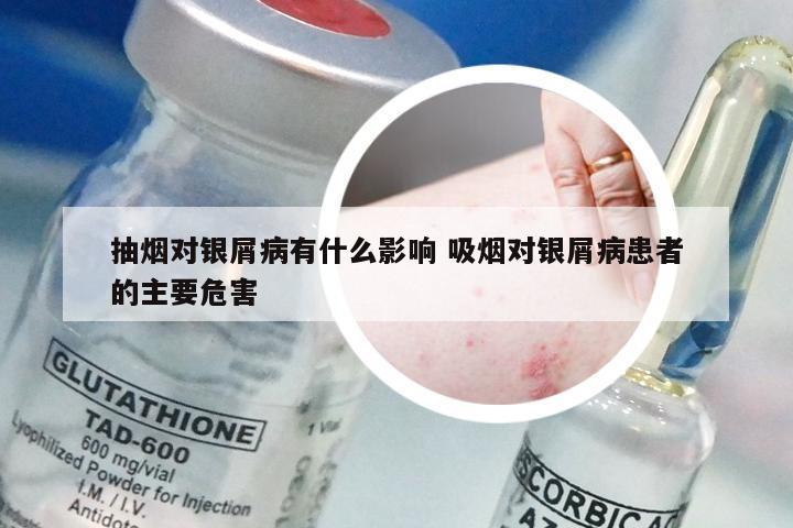 抽烟对银屑病有什么影响 吸烟对银屑病患者的主要危害