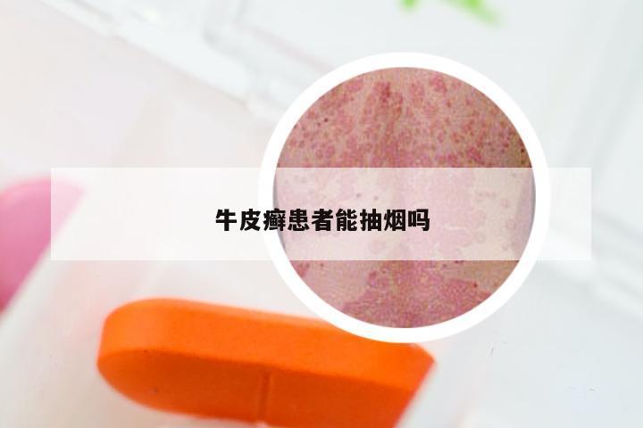 牛皮癣患者能抽烟吗