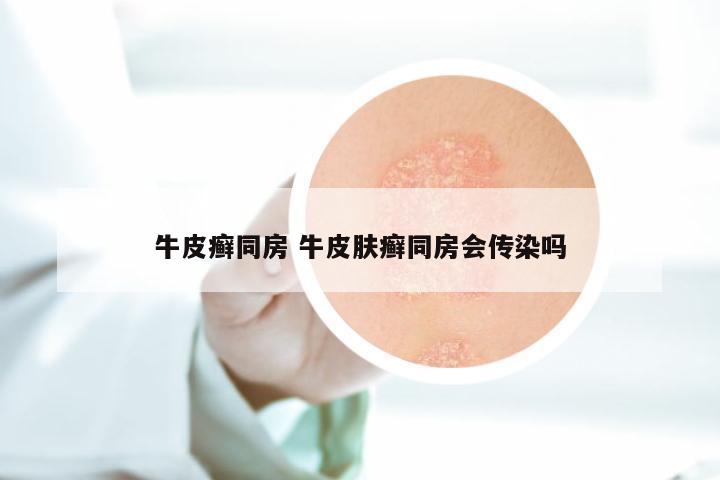 牛皮癣同房 牛皮肤癣同房会传染吗