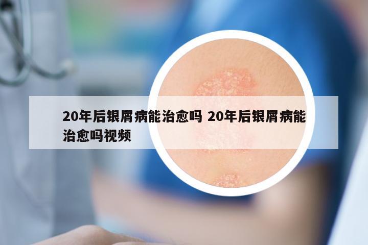20年后银屑病能治愈吗 20年后银屑病能治愈吗视频