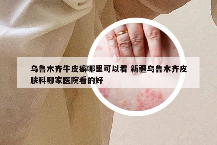 乌鲁木齐牛皮癣哪里可以看 新疆乌鲁木齐皮肤科哪家医院看的好