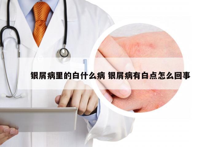 银屑病里的白什么病 银屑病有白点怎么回事