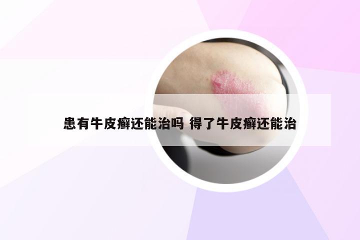 患有牛皮癣还能治吗 得了牛皮癣还能治