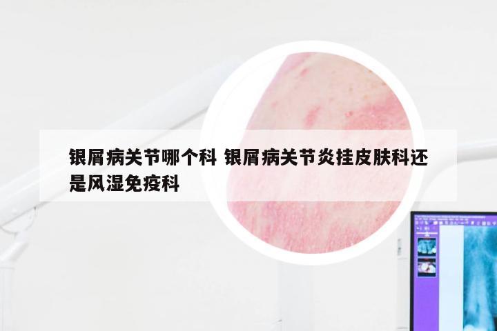 银屑病关节哪个科 银屑病关节炎挂皮肤科还是风湿免疫科