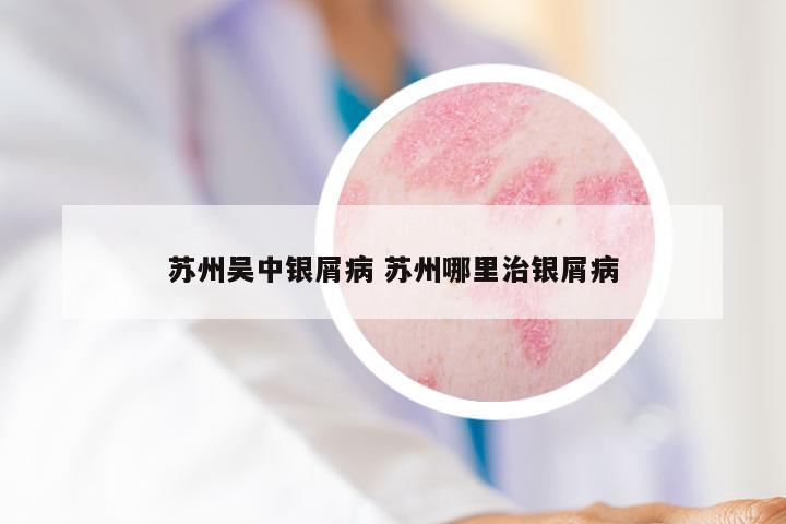 苏州吴中银屑病 苏州哪里治银屑病