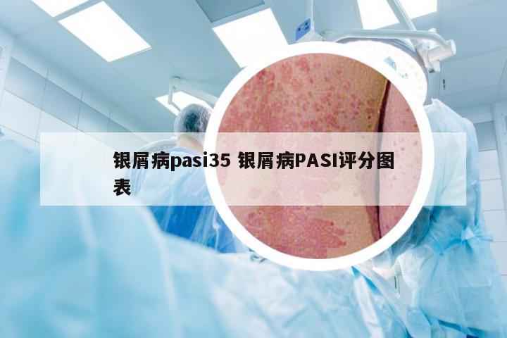 银屑病pasi35 银屑病PASI评分图表