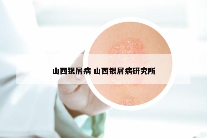 山西银屑病 山西银屑病研究所