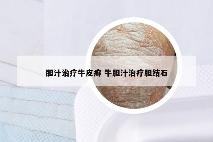 胆汁治疗牛皮癣 牛胆汁治疗胆结石