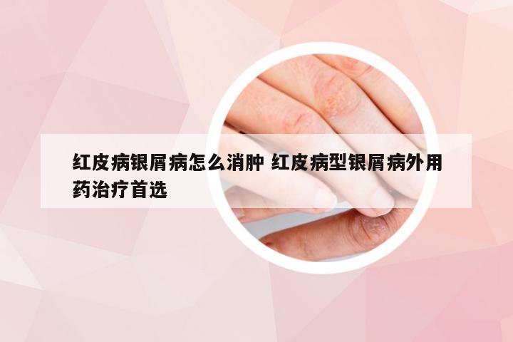 红皮病银屑病怎么消肿 红皮病型银屑病外用药治疗首选