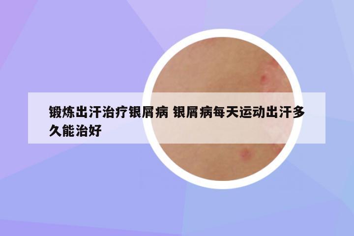 锻炼出汗治疗银屑病 银屑病每天运动出汗多久能治好