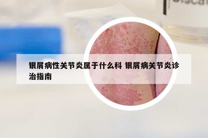 银屑病性关节炎属于什么科 银屑病关节炎诊治指南