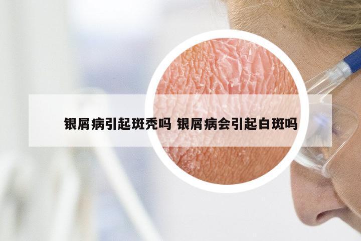 银屑病引起斑秃吗 银屑病会引起白斑吗