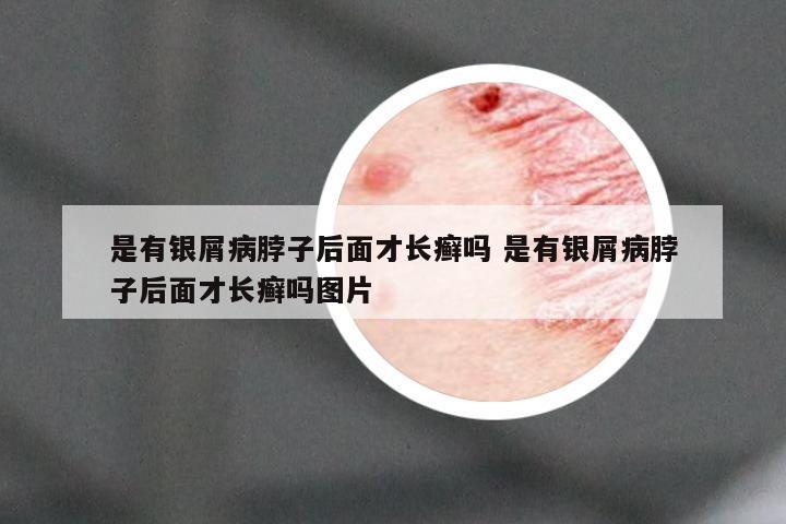 是有银屑病脖子后面才长癣吗 是有银屑病脖子后面才长癣吗图片