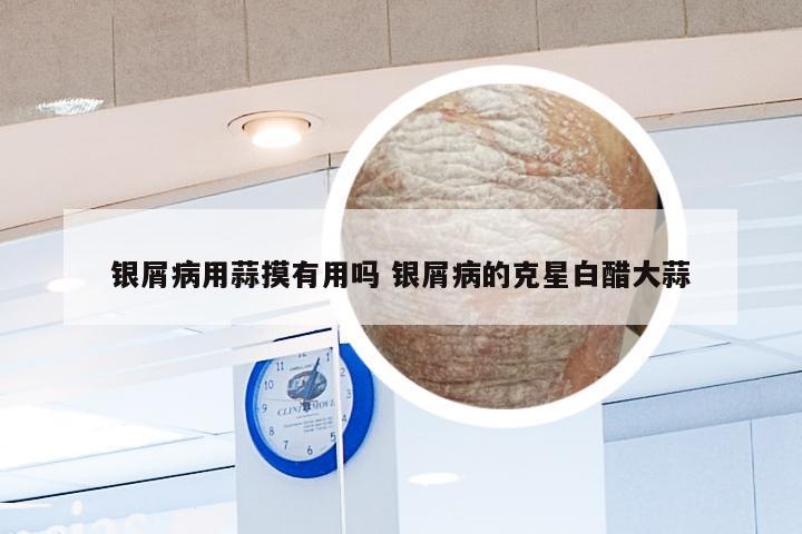 银屑病用蒜摸有用吗 银屑病的克星白醋大蒜