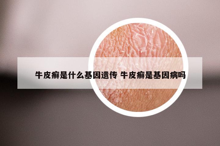 牛皮癣是什么基因遗传 牛皮癣是基因病吗