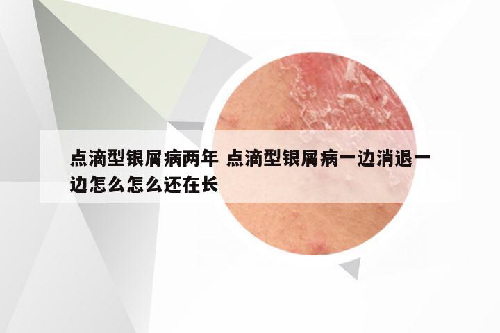 点滴型银屑病两年 点滴型银屑病一边消退一边怎么怎么还在长