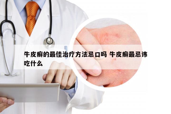 牛皮癣的最佳治疗方法忌口吗 牛皮癣最忌讳吃什么