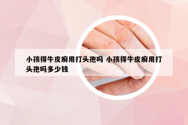 小孩得牛皮癣用打头孢吗 小孩得牛皮癣用打头孢吗多少钱