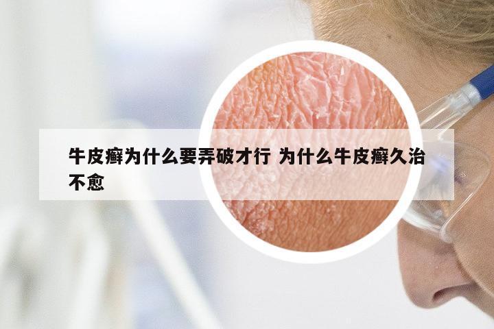 牛皮癣为什么要弄破才行 为什么牛皮癣久治不愈