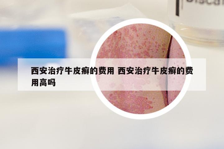 西安治疗牛皮癣的费用 西安治疗牛皮癣的费用高吗