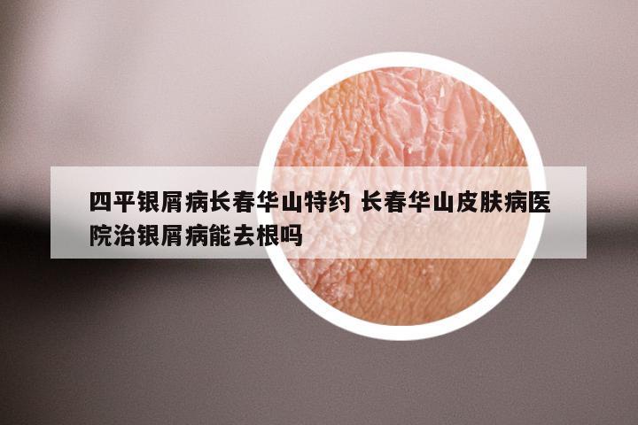 四平银屑病长春华山特约 长春华山皮肤病医院治银屑病能去根吗