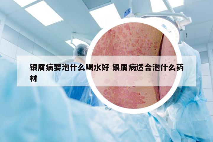 银屑病要泡什么喝水好 银屑病适合泡什么药材