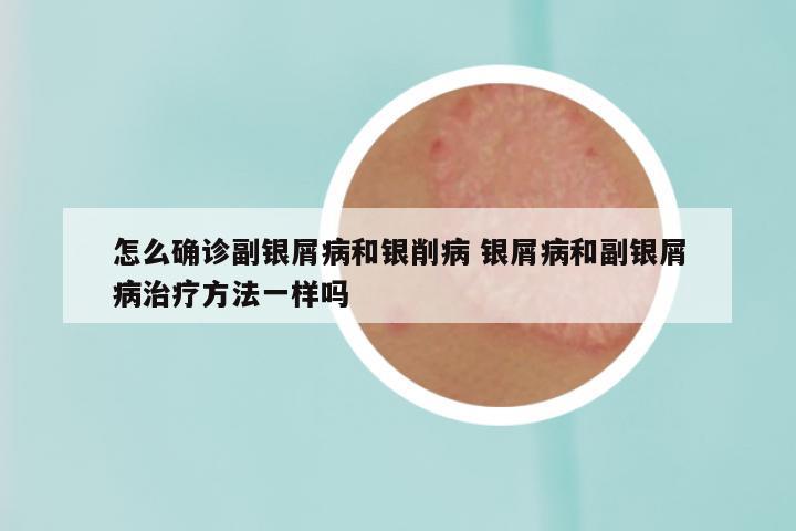 怎么确诊副银屑病和银削病 银屑病和副银屑病治疗方法一样吗