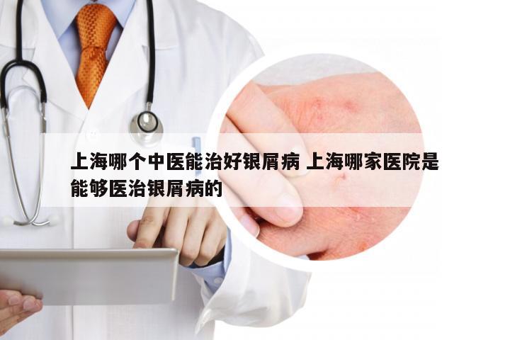 上海哪个中医能治好银屑病 上海哪家医院是能够医治银屑病的