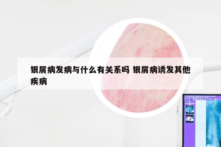 银屑病发病与什么有关系吗 银屑病诱发其他疾病
