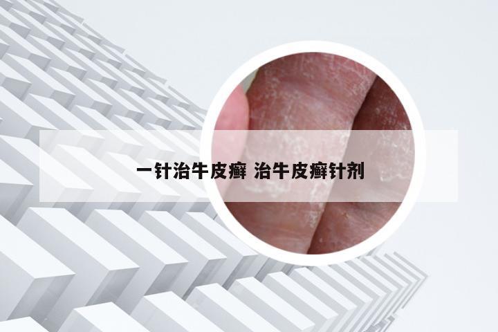 一针治牛皮癣 治牛皮癣针剂