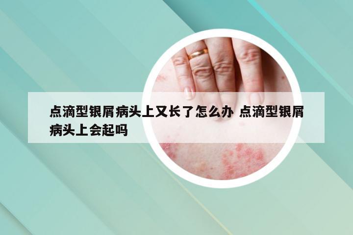 点滴型银屑病头上又长了怎么办 点滴型银屑病头上会起吗