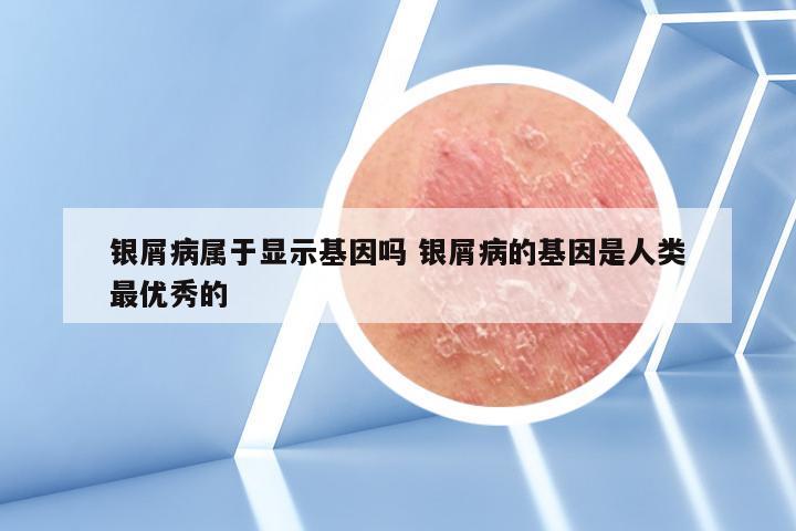 银屑病属于显示基因吗 银屑病的基因是人类最优秀的