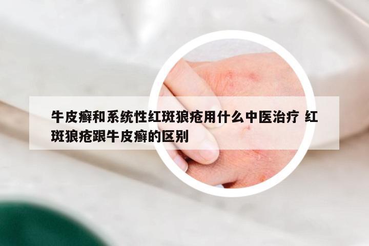 牛皮癣和系统性红斑狼疮用什么中医治疗 红斑狼疮跟牛皮癣的区别