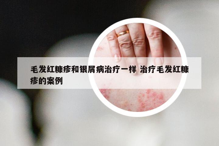 毛发红糠疹和银屑病治疗一样 治疗毛发红糠疹的案例