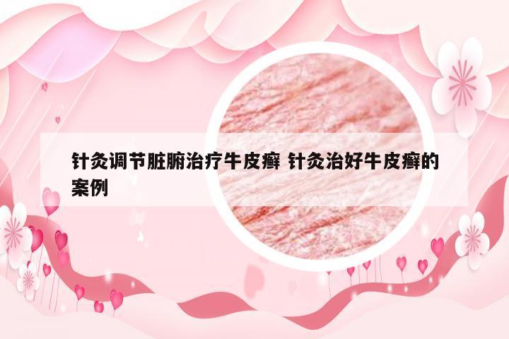 针灸调节脏腑治疗牛皮癣 针灸治好牛皮癣的案例