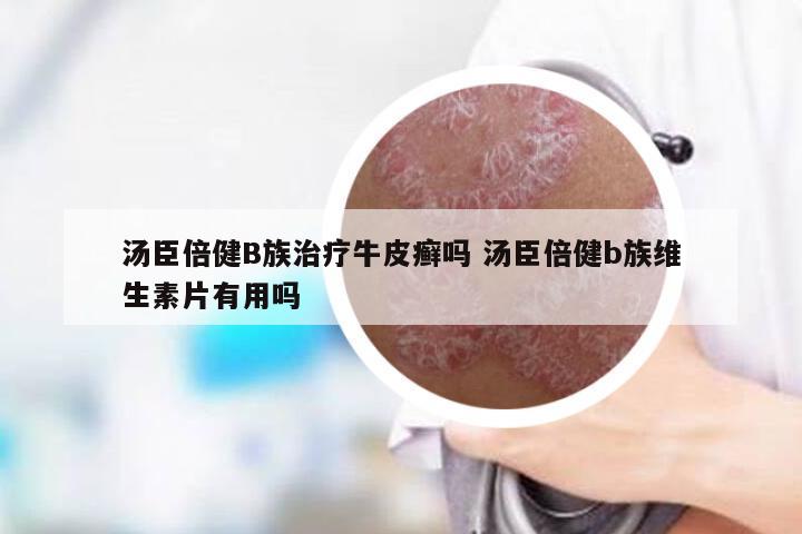 汤臣倍健B族治疗牛皮癣吗 汤臣倍健b族维生素片有用吗