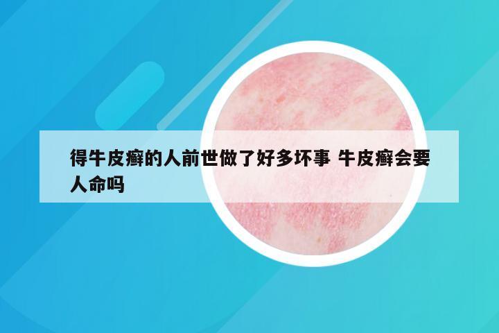 得牛皮癣的人前世做了好多坏事 牛皮癣会要人命吗