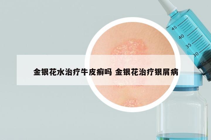 金银花水治疗牛皮癣吗 金银花治疗银屑病