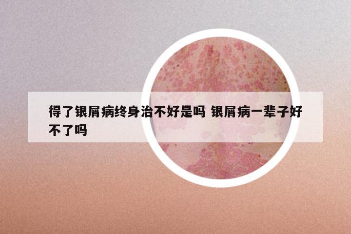 得了银屑病终身治不好是吗 银屑病一辈子好不了吗