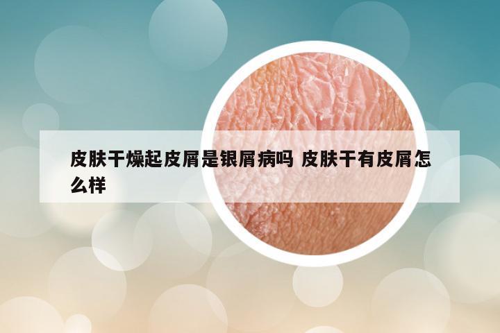 皮肤干燥起皮屑是银屑病吗 皮肤干有皮屑怎么样