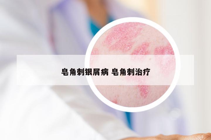 皂角刺银屑病 皂角刺治疗