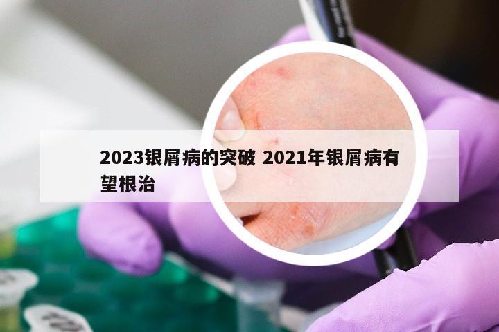 2023银屑病的突破 2021年银屑病有望根治