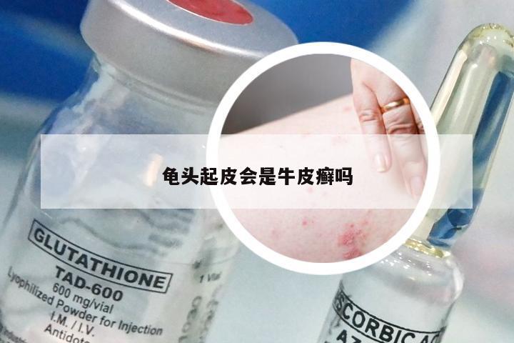 龟头起皮会是牛皮癣吗