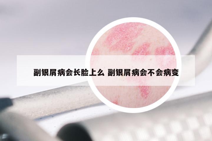 副银屑病会长脸上么 副银屑病会不会病变