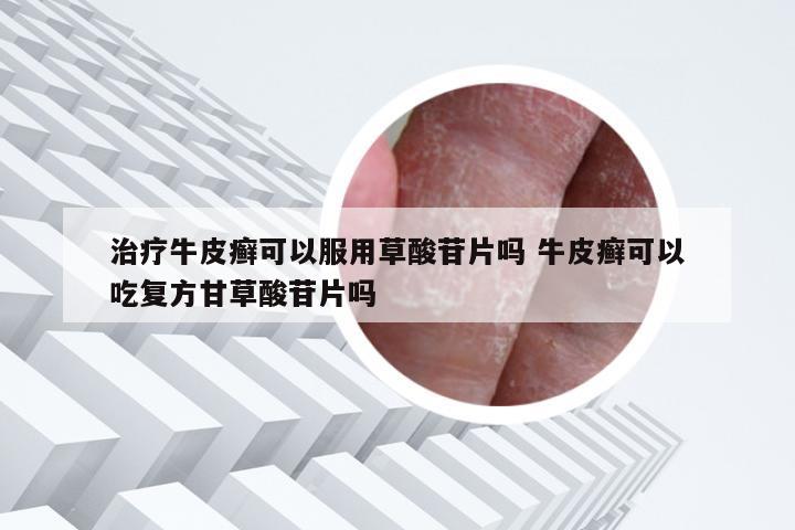 治疗牛皮癣可以服用草酸苷片吗 牛皮癣可以吃复方甘草酸苷片吗