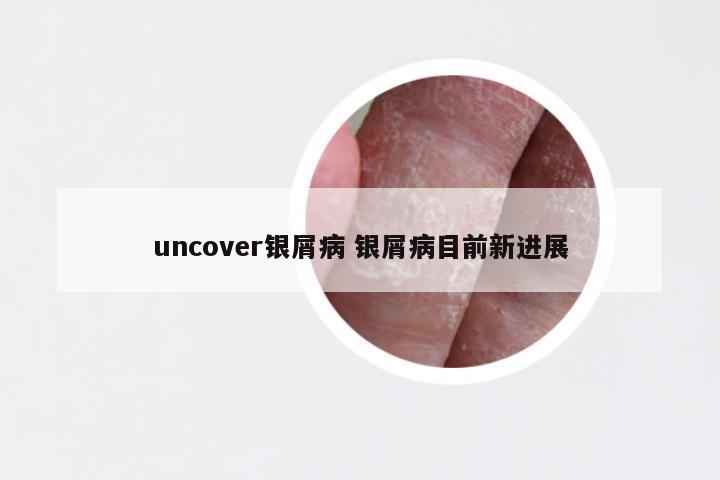 uncover银屑病 银屑病目前新进展